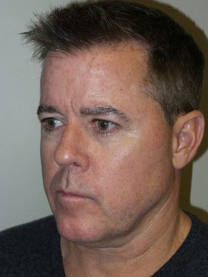 Facelift Before and After 23 | Grover Aesthetics