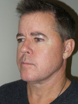 Facelift Before and After 23 | Grover Aesthetics