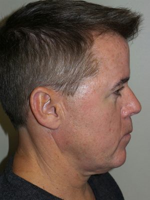 Facelift Before and After 23 | Sanjay Grover MD FACS