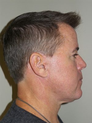 Facelift Before and After 23 | Sanjay Grover MD FACS