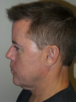 Facelift Before and After 23 | Sanjay Grover MD FACS