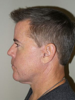 Facelift Before and After 23 | Sanjay Grover MD FACS