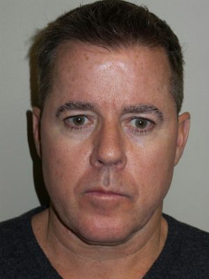 Facelift Before and After 23 | Grover Aesthetics