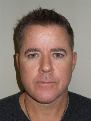 Facelift Before and After 23 | Grover Aesthetics