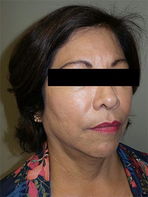 Facelift Before and After | Grover Aesthetics