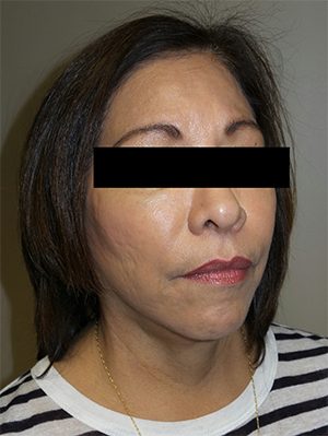 Facelift Before and After 24 | Sanjay Grover MD FACS