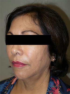 Facelift Before and After 24 | Sanjay Grover MD FACS