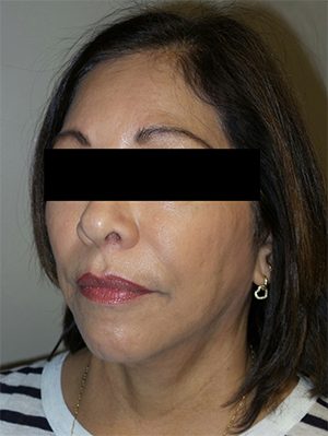 Facelift Before and After 24 | Sanjay Grover MD FACS