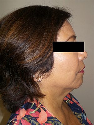 Facelift Before and After 24 | Sanjay Grover MD FACS