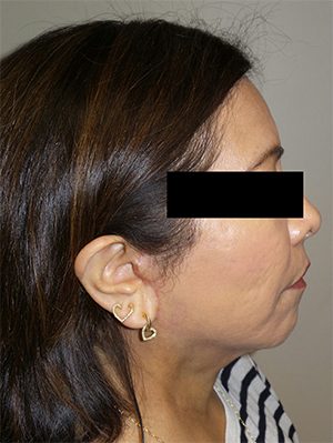 Facelift Before and After 24 | Grover Aesthetics