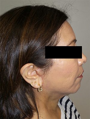 Facelift Before and After 24 | Sanjay Grover MD FACS