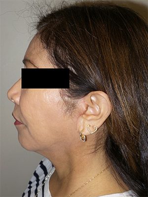 Facelift Before and After 24 | Sanjay Grover MD FACS