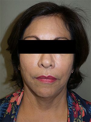 Facelift Before and After 24 | Sanjay Grover MD FACS