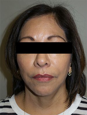 Facelift Before and After 24 | Sanjay Grover MD FACS