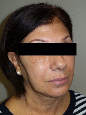 Facelift Before and After | Grover Aesthetics