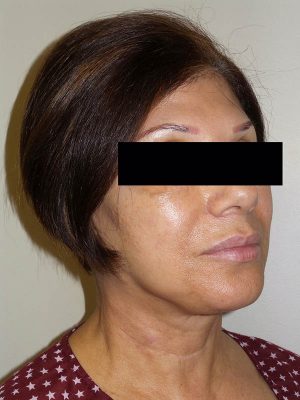 Facelift Before and After | Grover Aesthetics