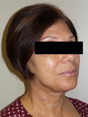 Facelift Before and After 25 | Sanjay Grover MD FACS