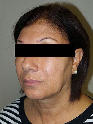 Facelift Before and After 25 | Sanjay Grover MD FACS