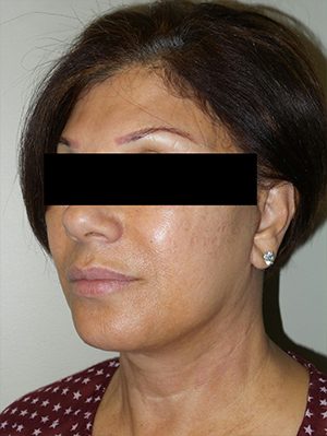 Facelift Before and After 25 | Sanjay Grover MD FACS