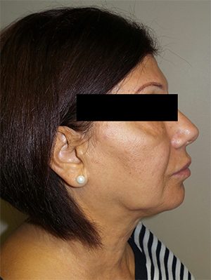 Facelift Before and After 25 | Grover Aesthetics