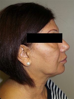 Facelift Before and After 25 | Sanjay Grover MD FACS