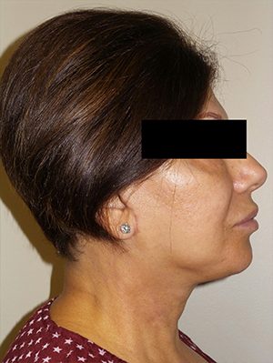 Facelift Before and After 25 | Sanjay Grover MD FACS