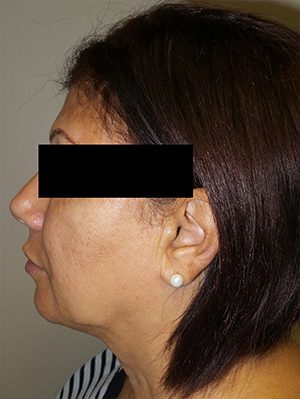 Facelift Before and After 25 | Grover Aesthetics