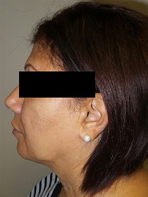 Facelift Before and After 25 | Sanjay Grover MD FACS