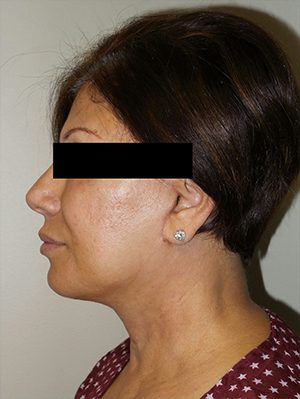 Facelift Before and After 25 | Sanjay Grover MD FACS