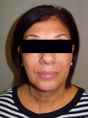 Facelift Before and After 25 | Sanjay Grover MD FACS