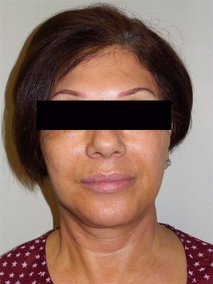 Facelift Before and After 25 | Sanjay Grover MD FACS