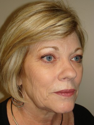 Facelift Before and After | Grover Aesthetics