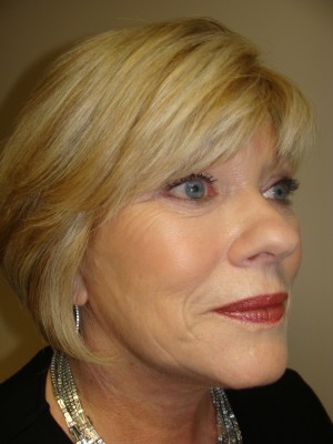 Facelift Before and After | Grover Aesthetics