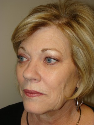 Facelift Before and After 26 | Sanjay Grover MD FACS