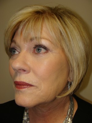 Facelift Before and After 26 | Sanjay Grover MD FACS
