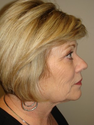Facelift Before and After 26 | Sanjay Grover MD FACS