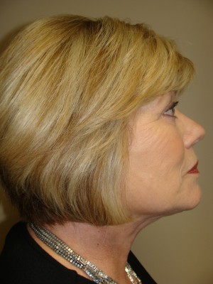 Facelift Before and After 26 | Sanjay Grover MD FACS