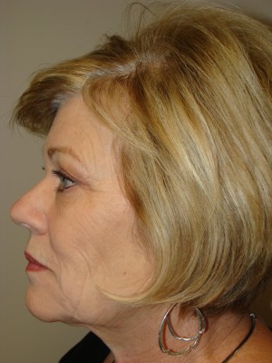 Facelift Before and After 26 | Sanjay Grover MD FACS
