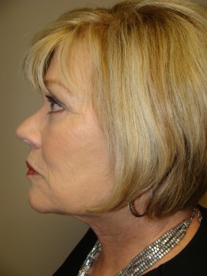 Facelift Before and After 26 | Sanjay Grover MD FACS