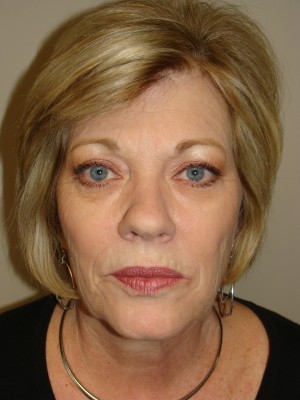 Facelift Before and After 26 | Sanjay Grover MD FACS