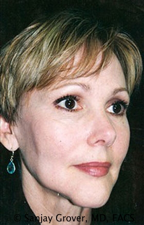 Facelift Before and After | Grover Aesthetics