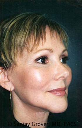 Facelift Before and After | Grover Aesthetics