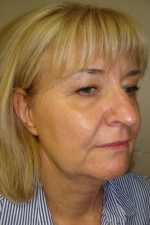 Facelift Before and After 17 | Sanjay Grover MD FACS
