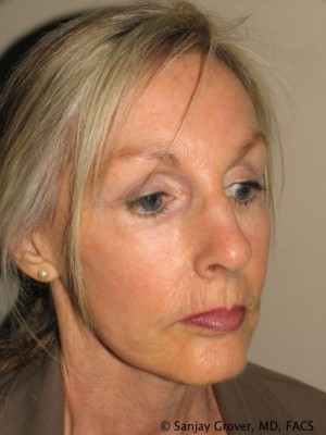 Facelift Before and After 30 | Sanjay Grover MD FACS