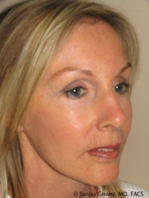 Facelift Before and After | Sanjay Grover MD FACS