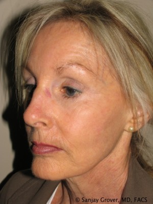 Facelift Before and After 28 | Sanjay Grover MD FACS