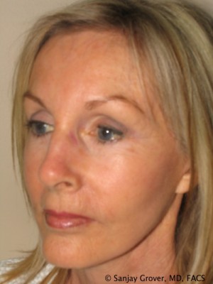 Facelift Before and After 28 | Sanjay Grover MD FACS