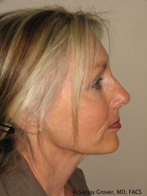 Facelift Before and After 28 | Grover Aesthetics