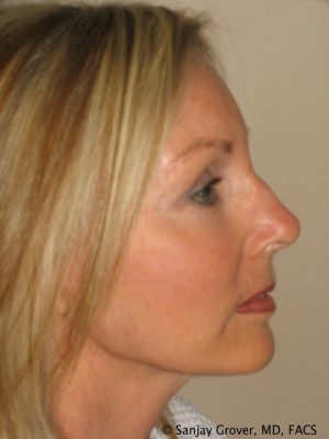 Facelift Before and After 28 | Sanjay Grover MD FACS