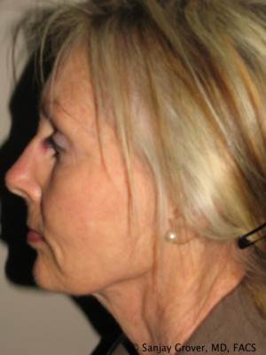 Facelift Before and After 28 | Sanjay Grover MD FACS